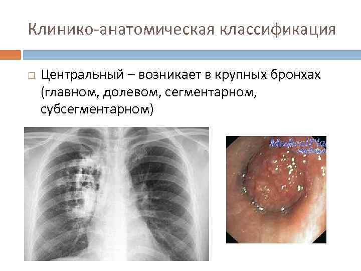 Клинико-анатомическая классификация Центральный – возникает в крупных бронхах (главном, долевом, сегментарном, субсегментарном) 