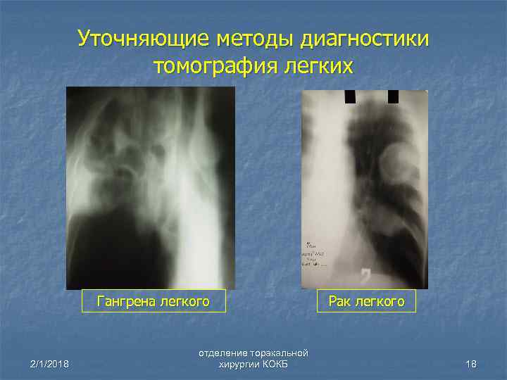 Уточняющие методы диагностики томография легких Гангрена легкого 2/1/2018 отделение торакальной хирургии КОКБ Рак легкого