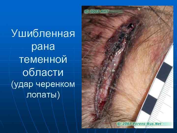 Ушибленная рана теменной области (удар черенком лопаты) 