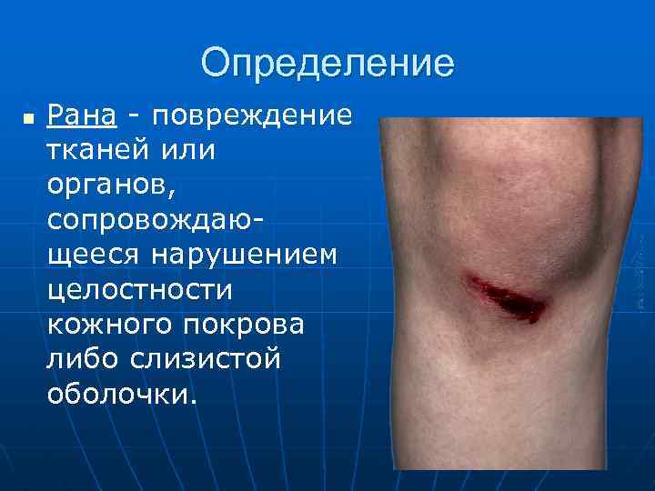 Определение n Рана - повреждение тканей или органов, сопровождающееся нарушением целостности кожного покрова либо