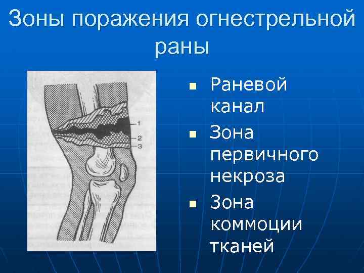 Зоны поражения огнестрельной раны n n n Раневой канал Зона первичного некроза 3 она