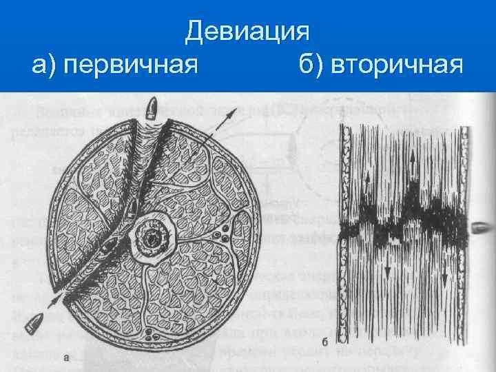 Девиация а) первичная б) вторичная 