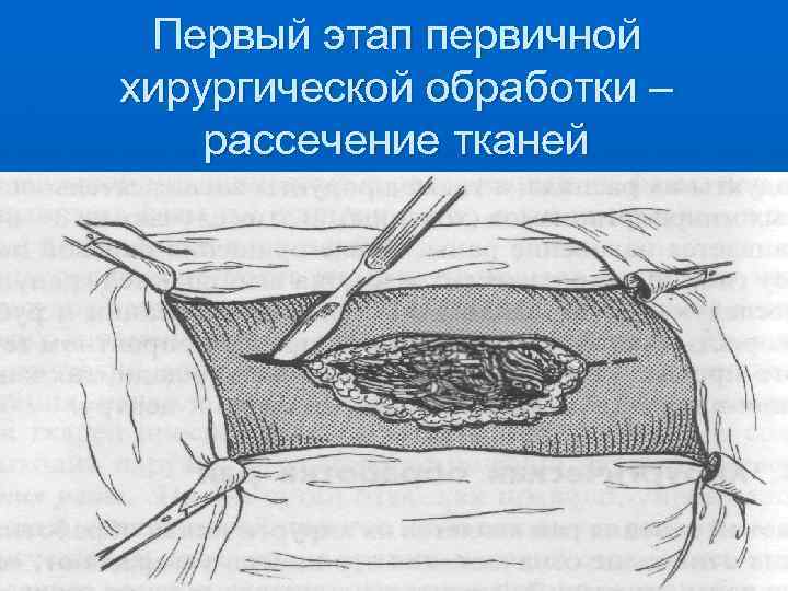 Первый этап первичной хирургической обработки – рассечение тканей 
