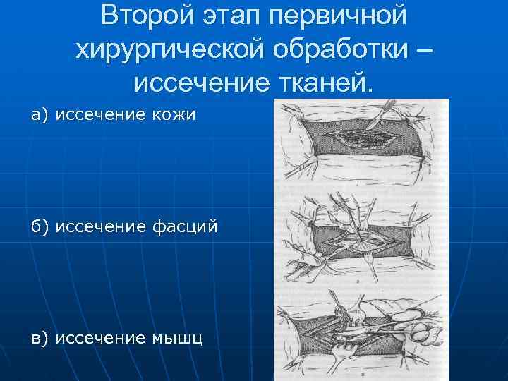 Второй этап первичной хирургической обработки – иссечение тканей. а) иссечение кожи б) иссечение фасций
