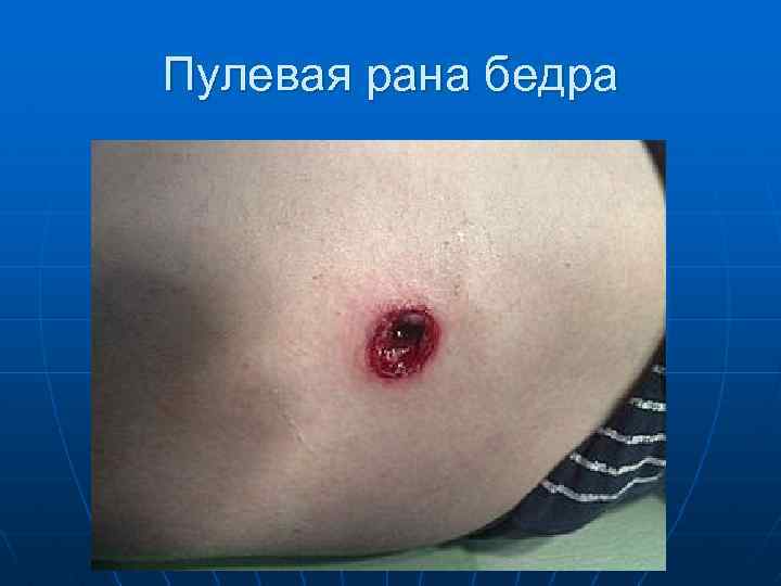 Пулевая рана бедра 