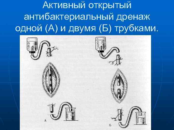 Активный открытый антибактериальный дренаж одной (А) и двумя (Б) трубками. 