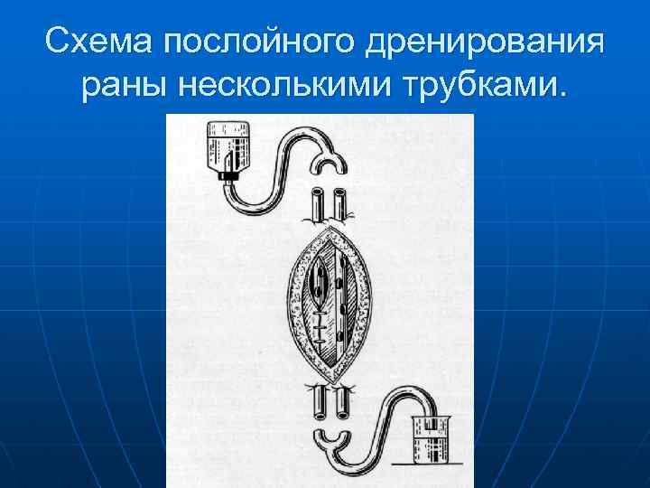 Схема послойного дренирования раны несколькими трубками. 