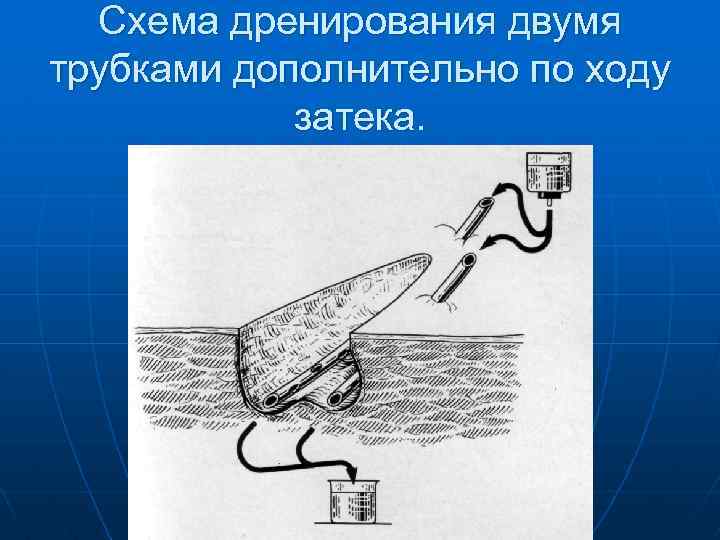 Схема дренирования двумя трубками дополнительно по ходу затека. 