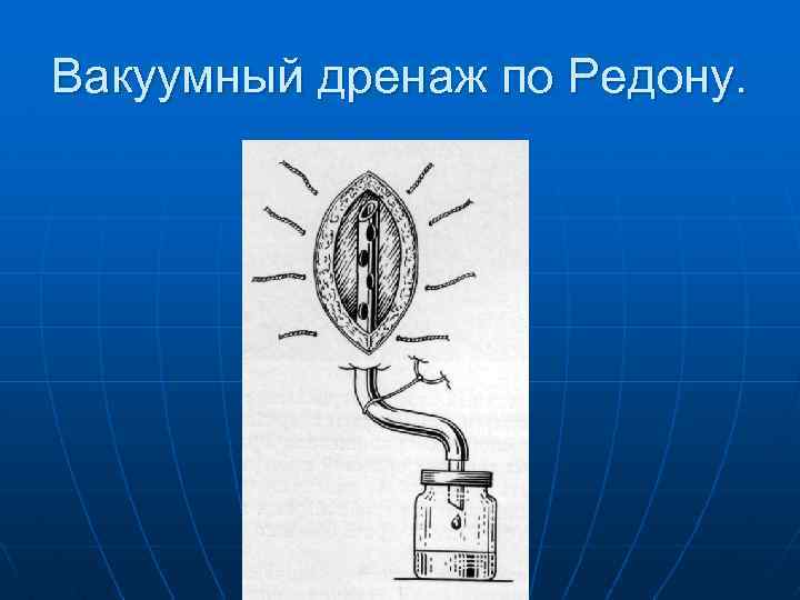 Вакуумный дренаж по Редону. 