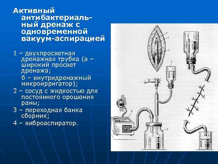 Активный антибактериальный дренаж с одновременной вакуум-аспирацией 1 – двухпросветная дренажная трубка (а – широкий