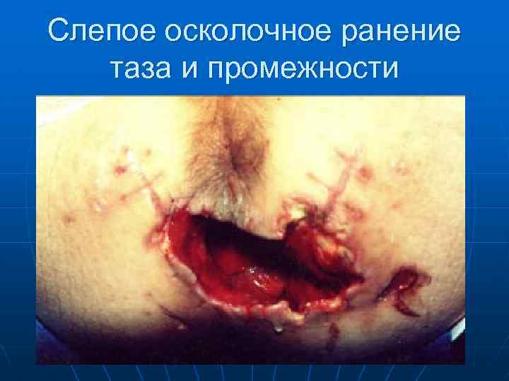 Слепое осколочное ранение таза и промежности 