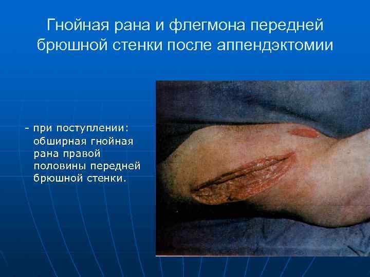 Гнойная рана и флегмона передней брюшной стенки после аппендэктомии - при поступлении: обширная гнойная