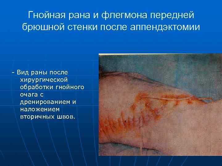 Гнойная рана и флегмона передней брюшной стенки после аппендэктомии - Вид раны после хирургической