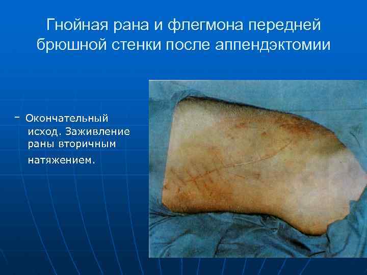 Гнойная рана и флегмона передней брюшной стенки после аппендэктомии - Окончательный исход. Заживление раны