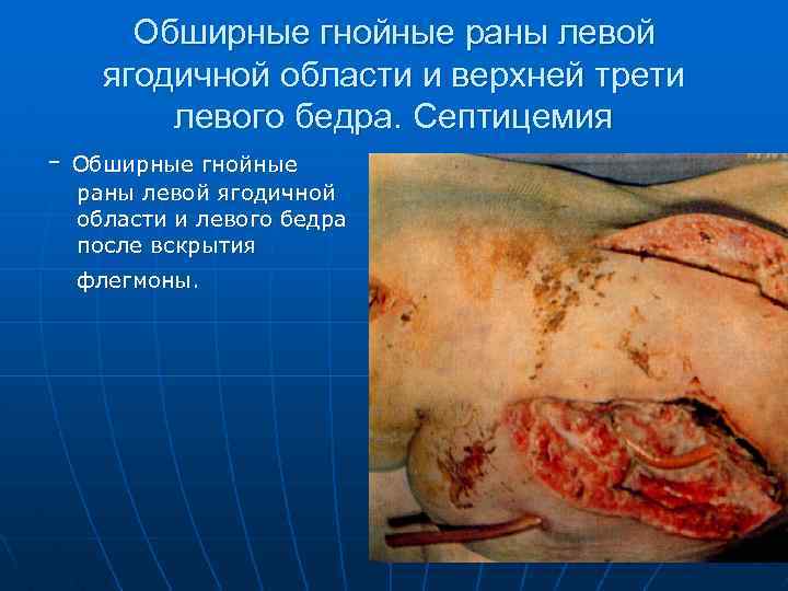 Обширные гнойные раны левой ягодичной области и верхней трети левого бедра. Септицемия - Обширные