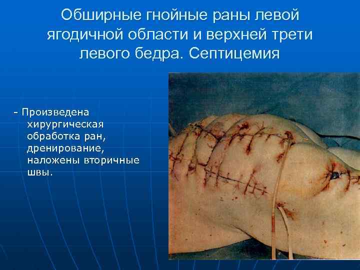 Обширные гнойные раны левой ягодичной области и верхней трети левого бедра. Септицемия - Произведена