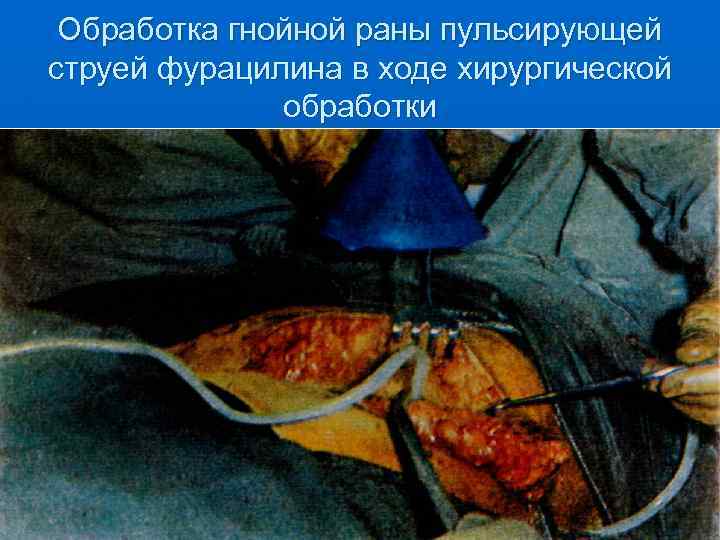 Обработка гнойной раны пульсирующей струей фурацилина в ходе хирургической обработки 