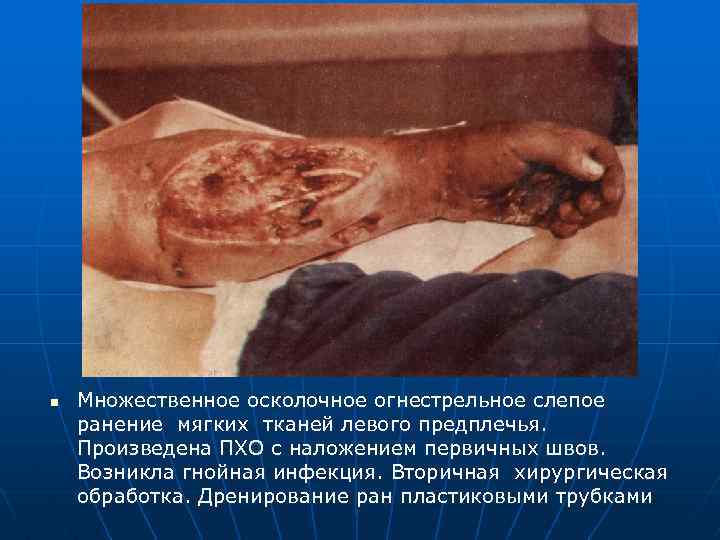 n Множественное осколочное огнестрельное слепое ранение мягких тканей левого предплечья. Произведена ПХО с наложением