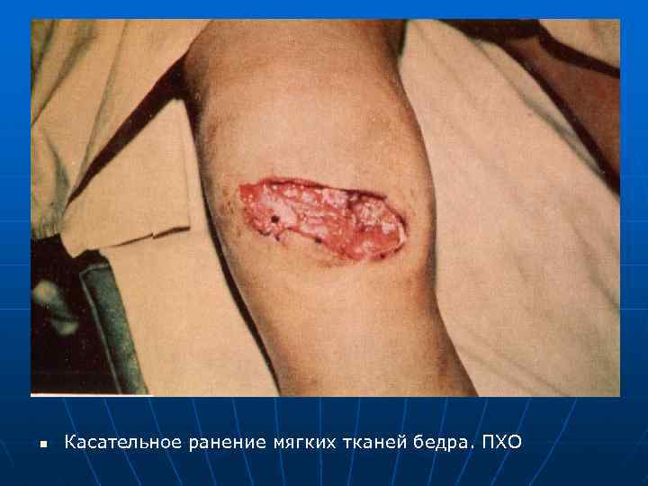 n Касательное ранение мягких тканей бедра. ПХО 