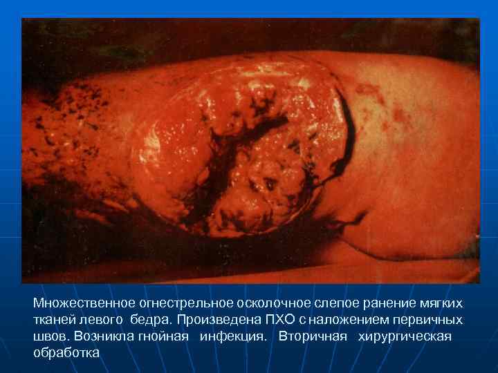 Множественное огнестрельное осколочное слепое ранение мягких тканей левого бедра. Произведена ПХО с наложением первичных