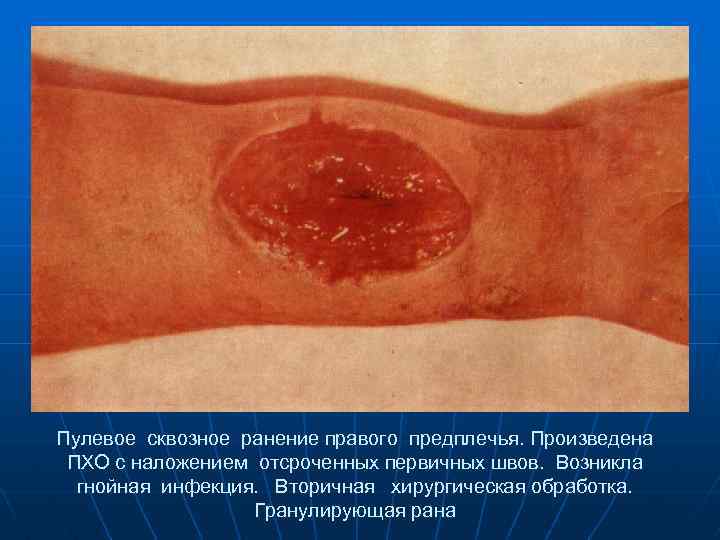 Пулевое сквозное ранение правого предплечья. Произведена ПХО с наложением отсроченных первичных швов. Возникла гнойная
