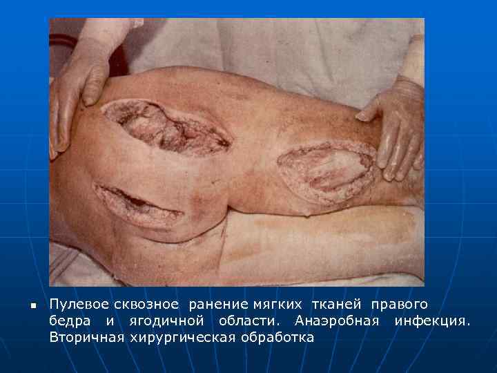 n Пулевое сквозное ранение мягких тканей правого бедра и ягодичной области. Анаэробная инфекция. Вторичная