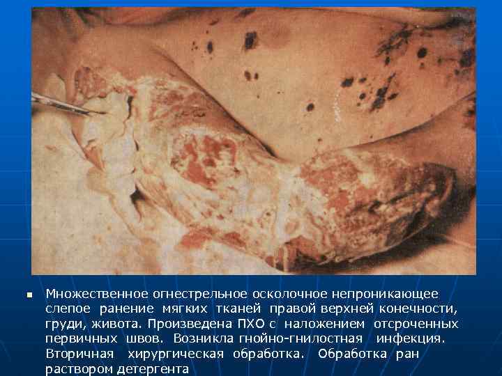 n Множественное огнестрельное осколочное непроникающее слепое ранение мягких тканей правой верхней конечности, груди, живота.