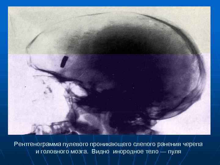 Рентгенограмма пулевого проникающего слепого ранения черепа и головного мозга. Видно инородное тело — пуля