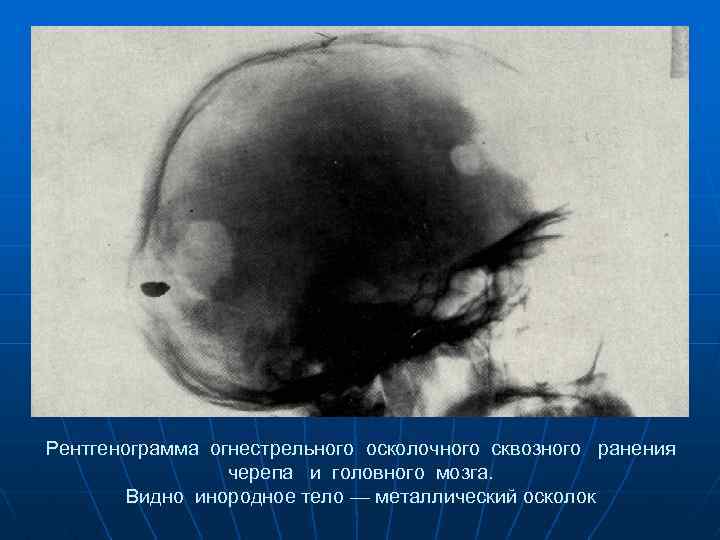 Рентгенограмма огнестрельного осколочного сквозного ранения черепа и головного мозга. Видно инородное тело — металлический