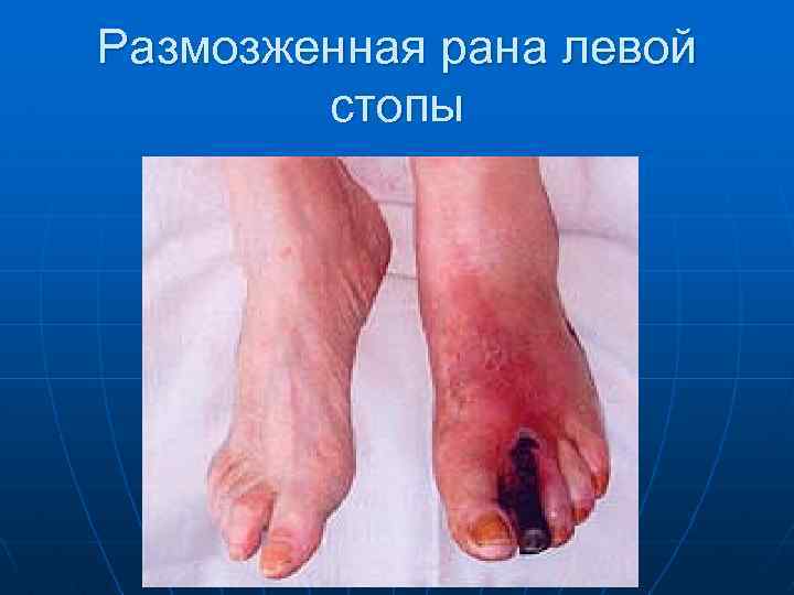 Размозженная рана левой стопы 