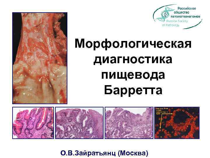 Морфологическая диагностика пищевода Барретта О. В. Зайратьянц (Москва) 