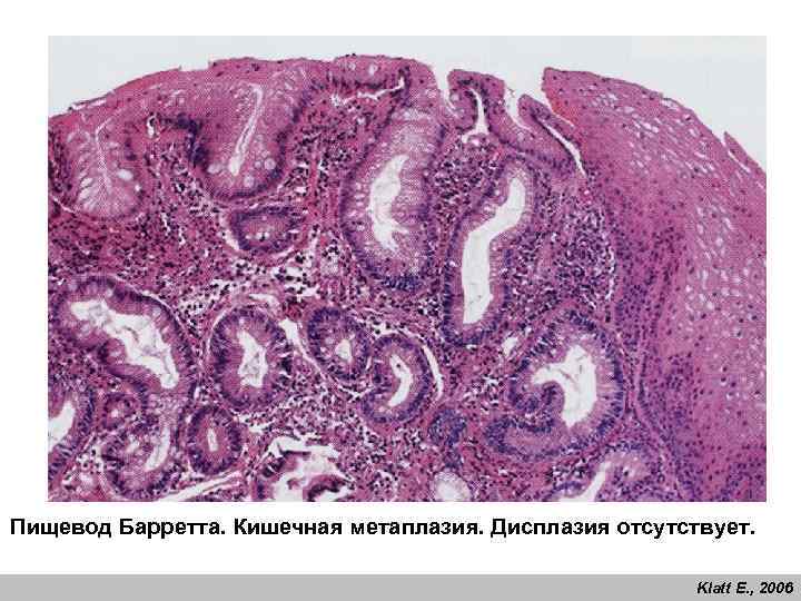 Пищевод Барретта. Кишечная метаплазия. Дисплазия отсутствует. Klatt E. , 2006 