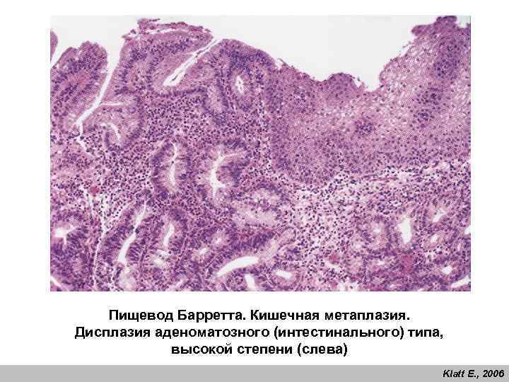Пищевод Барретта. Кишечная метаплазия. Дисплазия аденоматозного (интестинального) типа, высокой степени (слева) Klatt E. ,