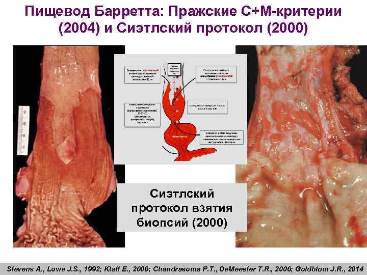 Пищевод Барретта: Пражские С+М-критерии (2004) и Сиэтлский протокол (2000) Сиэтлский протокол взятия биопсий (2000)
