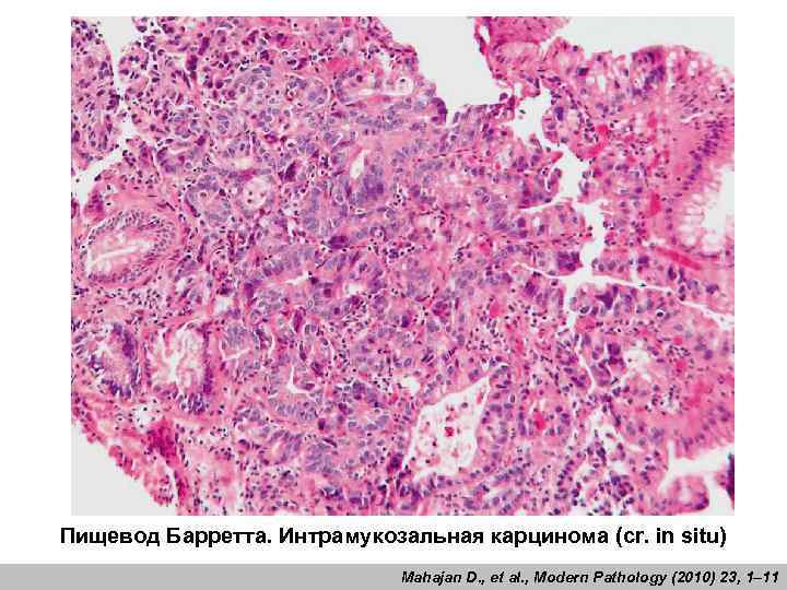 Карцинома in situ. Аденокарцинома Барретта гистология. Пищевод Барретта аденокарцинома. Интрамукозальная аденокарцинома. Пищевод Барретта аденокарцинома микропрепарат.