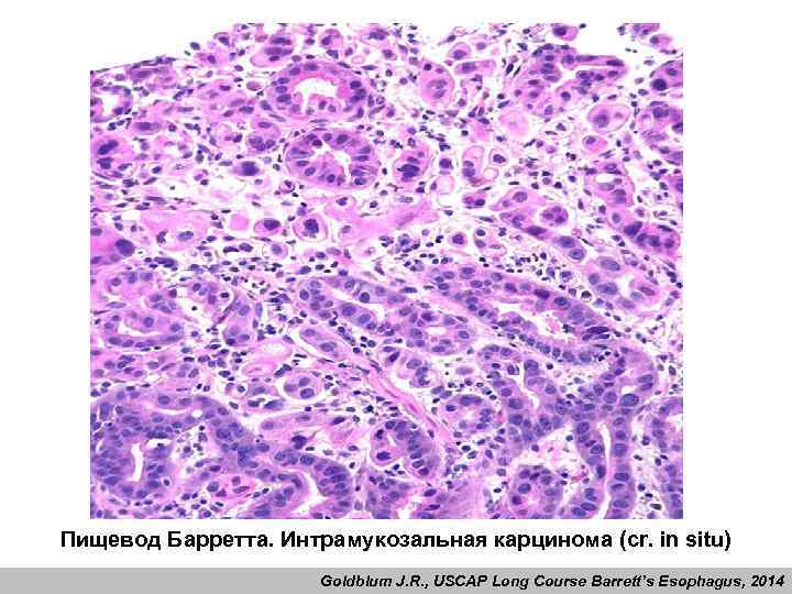 Пищевод Барретта. Интрамукозальная карцинома (cr. in situ) Goldblum J. R. , USCAP Long Course