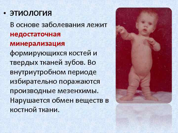  • ЭТИОЛОГИЯ В основе заболевания лежит недостаточная минерализация формирующихся костей и твердых тканей