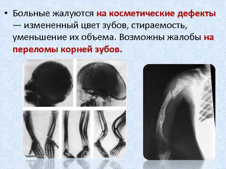  • Больные жалуются на косметические дефекты — измененный цвет зубов, стираемость, уменьшение их