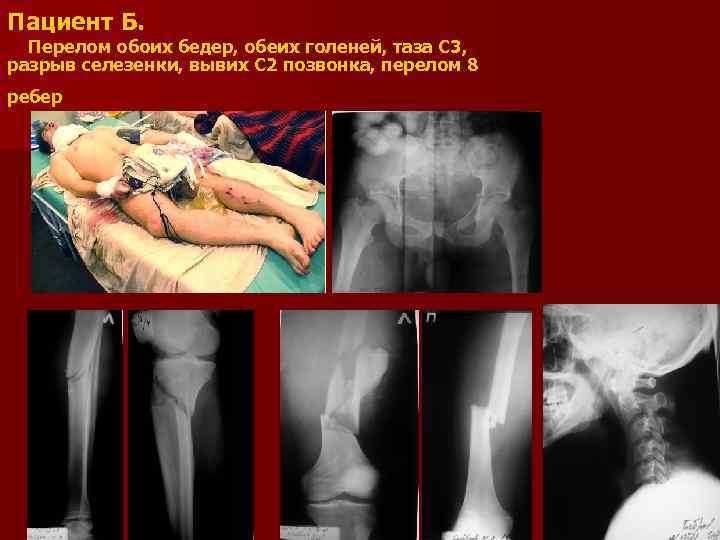 Пациент Б. Перелом обоих бедер, обеих голеней, таза С 3, разрыв селезенки, вывих С