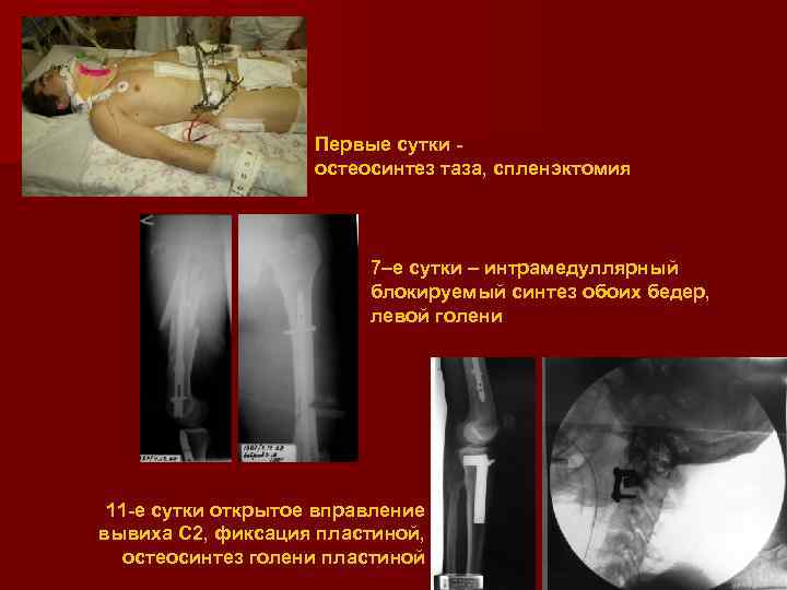 Первые сутки остеосинтез таза, спленэктомия 7–е сутки – интрамедуллярный блокируемый синтез обоих бедер, левой