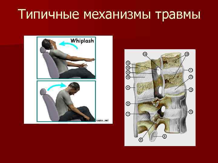 Типичные механизмы травмы 