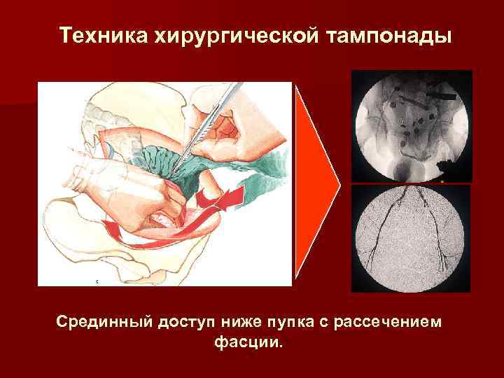 Техника хирургической тампонады Срединный доступ ниже пупка с рассечением фасции. 