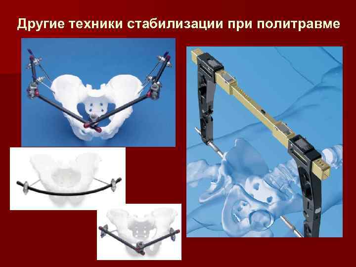 Другие техники стабилизации при политравме 