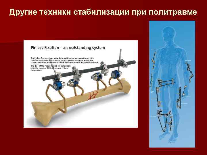 Другие техники стабилизации при политравме 