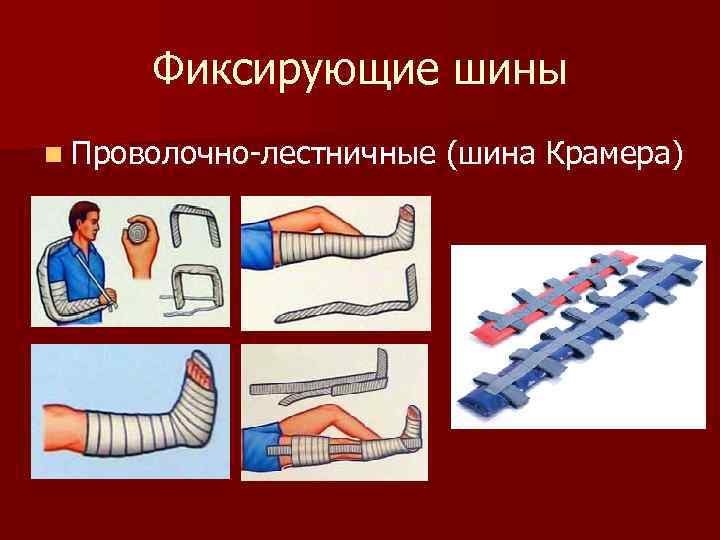 Фиксирующие шины n Проволочно-лестничные (шина Крамера) 