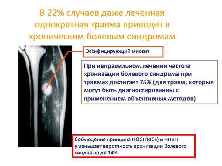 В 22% случаев даже леченная однократная травма приводит к хроническим болевым синдромам Оссифицирующий миозит