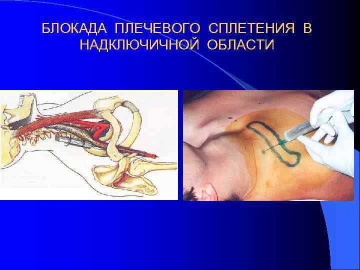 БЛОКАДА ПЛЕЧЕВОГО СПЛЕТЕНИЯ В НАДКЛЮЧИЧНОЙ ОБЛАСТИ 