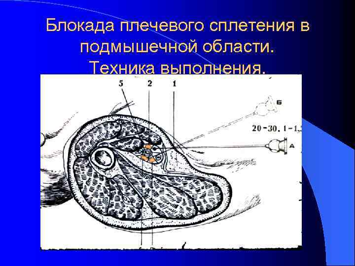 Блокада плечевого сплетения в подмышечной области. Техника выполнения. 