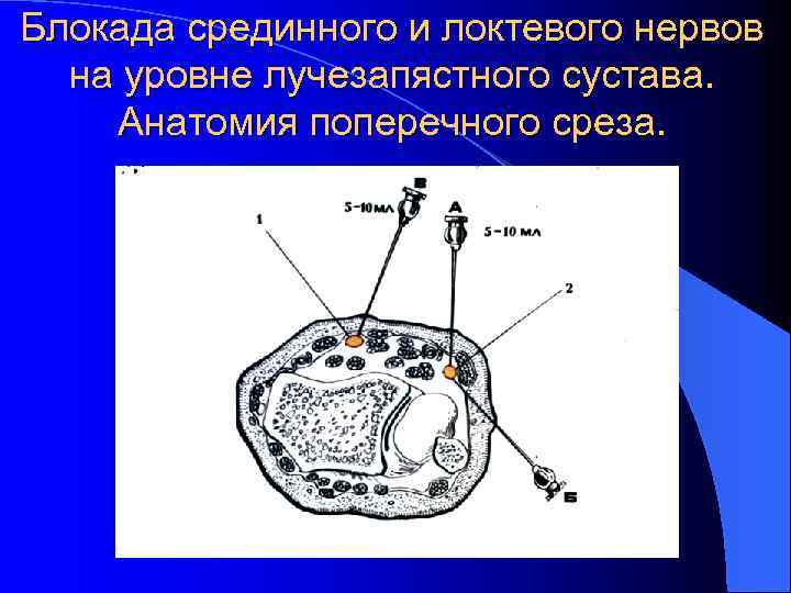 Блокада срединного и локтевого нервов на уровне лучезапястного сустава. Анатомия поперечного среза. 