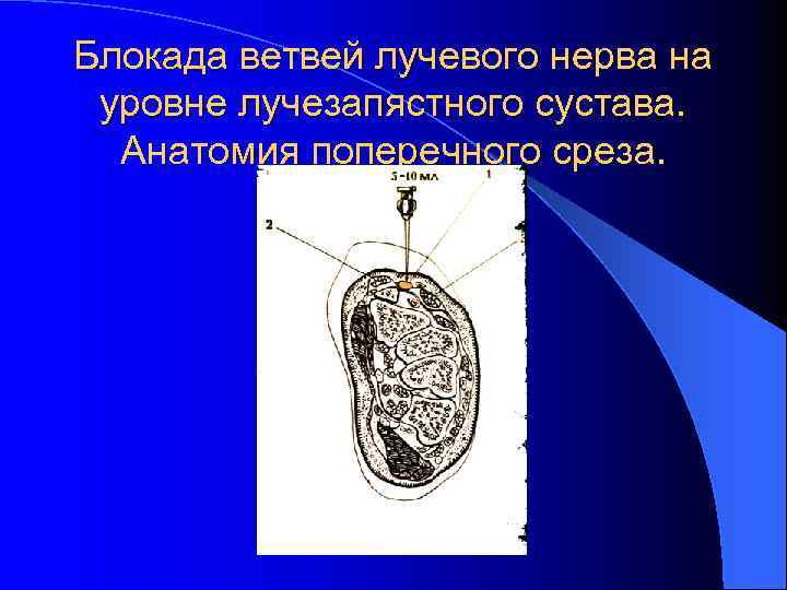 Блокада ветвей лучевого нерва на уровне лучезапястного сустава. Анатомия поперечного среза. 